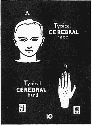 Benedict 1921: typical face and hand for the Cerebral type