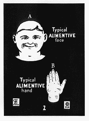Benedict 1921: typical face and hand for the Alimentive type